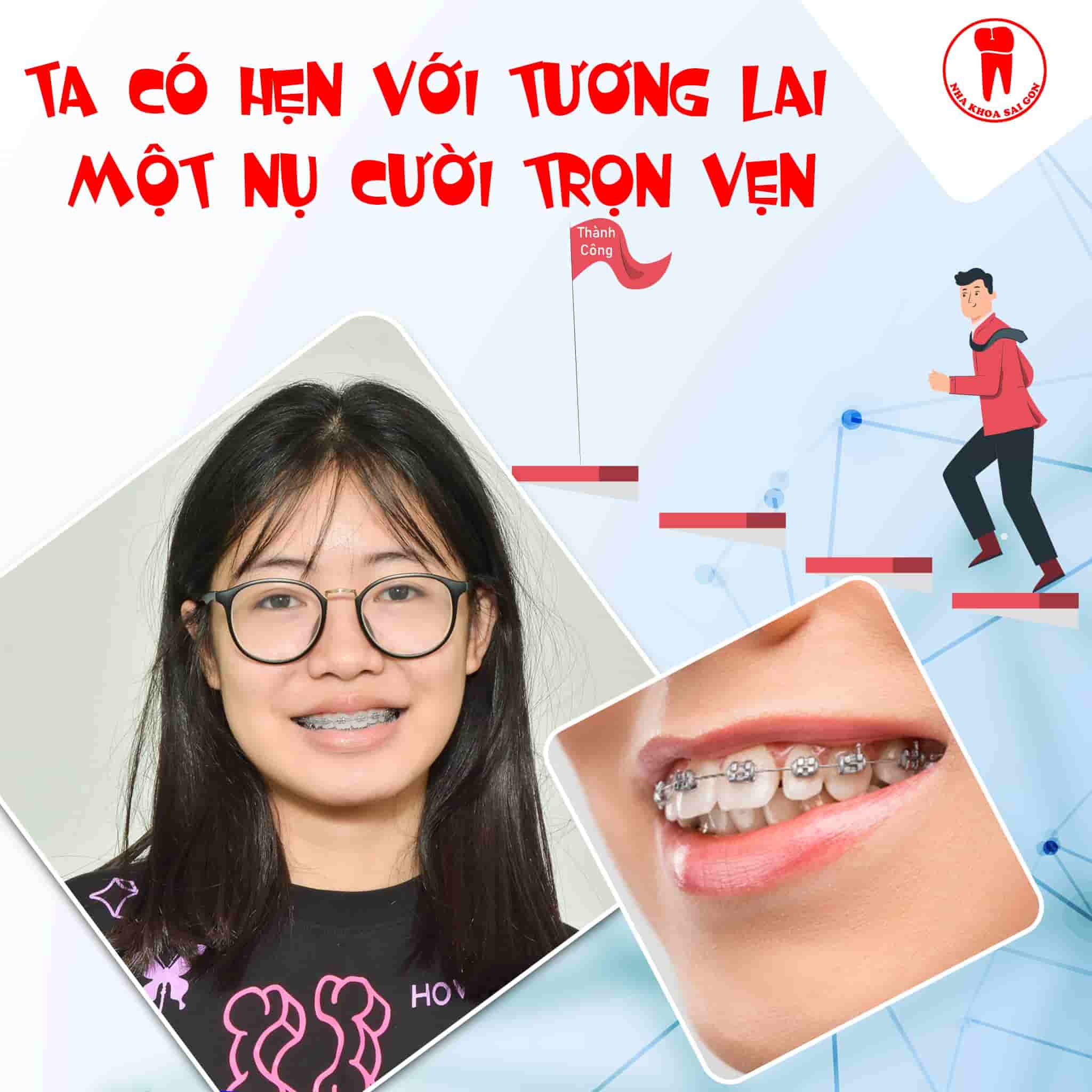 niềng răng Nha Trang