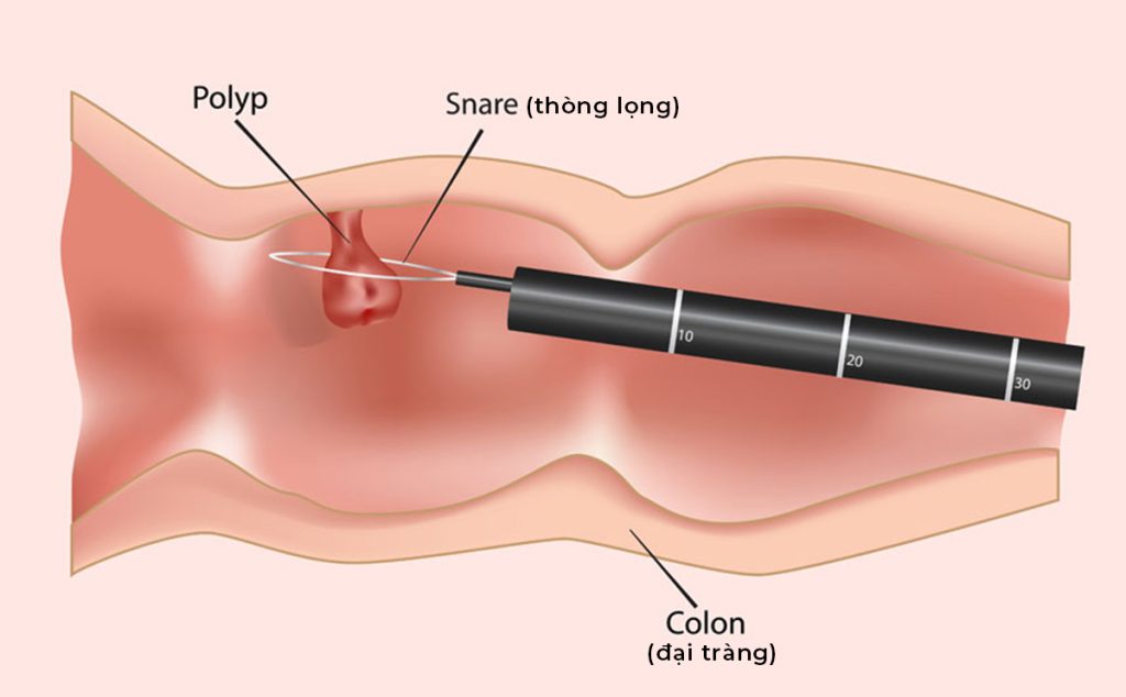những rủi ro và lợi ích khi nội soi những rủi ro và lợi ích khi nội soi