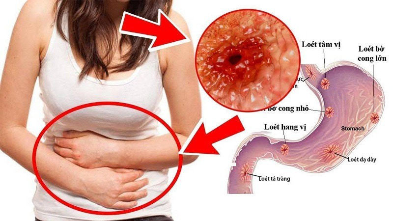 những rủi ro và lợi ích khi nội soi những rủi ro và lợi ích khi nội soi