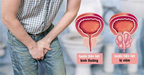 Các vấn đề thường gặp: rối loạn cương dương, viêm tuyến tiền liệt và yếu sinh lý