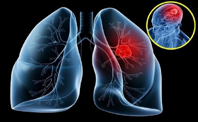 tầm soát ung thư bao gồm những xét nghiệm gì Tầm soát ung thư phổi