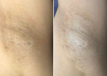 spa trị thâm nách đà nẵng